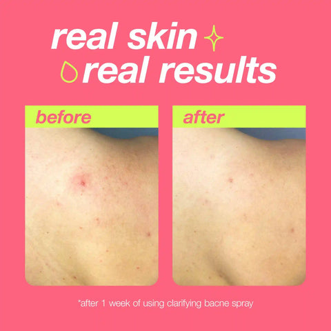 clarifying bacne spray