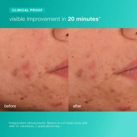 acne biotic moisturizer